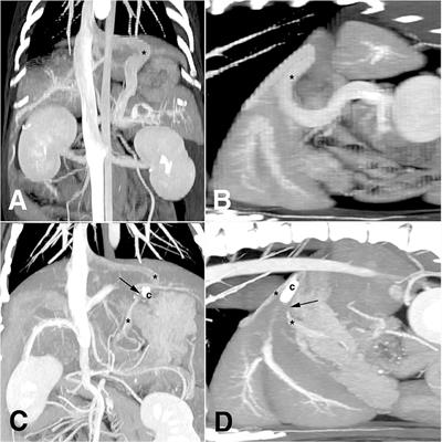 Laparoscopic attenuation of a congenital extrahepatic portosystemic shunt in a dog—a thin-film banding for splenophrenic shunt: A case report